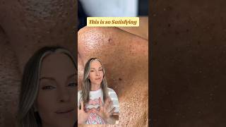 WOW A GIANT BLACKHEAD EXTRACTION  SATISFYING SEBACEOUS FILAMENT REMOVAL shorts [upl. by Anialem]