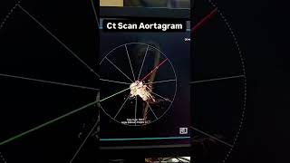 A CT Coronary Angiogram can identify calcification 👨‍⚕️👨‍💻 trendingshorts viralshorts video [upl. by Eitsyrk288]