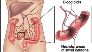 Mesenteric Ischemia [upl. by Suivatnom]