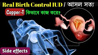 How IUD Works to Prevent Pregnancy Animation। Copper T Insertion and Side Effects । [upl. by Xad658]