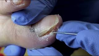 Ingrown Toenail Removal  Pedicure Treatment and Very Satisfying  Best Satisfying Nail Cutting [upl. by Brooks]