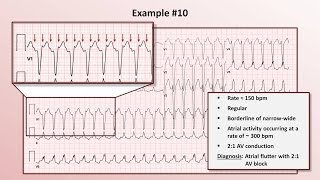 Intro to EKG Interpretation  Practicing Tachyarrhythmia Identification [upl. by Marabel]