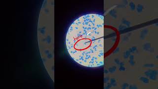 Mycobacterium tuberculosis in acid fast bacilli 🦠 [upl. by Htbazile]