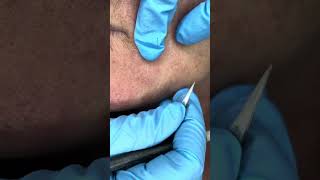 Watch Electrolysis Hair Removal in Action [upl. by Dazraf887]