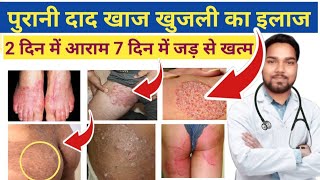 जांघों की दाद खाज खुजली खत्म  Home Remedies For Itching in Private Parts  Fungal infection [upl. by Elrebmik]