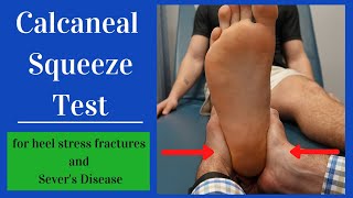 Calcaneal Squeeze Test Heel Squeeze [upl. by Ecineg730]