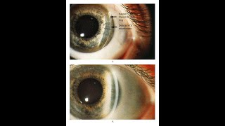 Kayser Fleischer Ring bei Patient mit Morbus Wilson [upl. by Durkee]