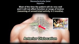 Sternoclavicular Joint Injuries  Everything You Need To Know  Dr Nabil Ebraheim [upl. by Annerahs]