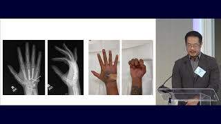 15 Metacarpal and Phalangeal Fractures Nicolas Lee MD 020 [upl. by Ijnek]