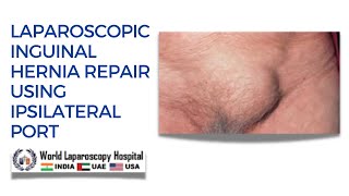 Laparoscopic TAPP Inguinal Hernia Repair Using Ipsilateral Port [upl. by Karee]