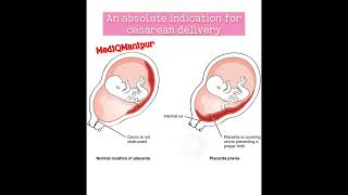 Placenta previa Cesarean sectiondoctor anatomy obstetrician nursing medicalstudent [upl. by Allimac]