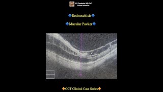 Retinoschisis Macular Pucker [upl. by Diskin]