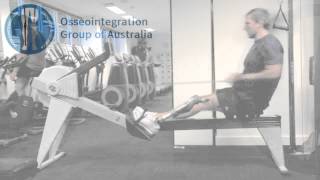 Benefits of Osseointegration  Patient Video [upl. by Anihsit]