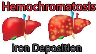 Hemochromatosis Easy explained symptoms causes treatment prognosis [upl. by Yerdna]