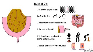 Meckel’s Diverticulum [upl. by Laux]