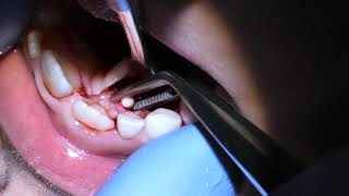 Compound Odontoma removal [upl. by Colvert]