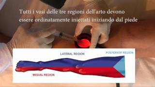 4 Dalla Scleroterapia e dalla Chirurgia Ablativa alla Fleboterapia TRAP [upl. by Gula]