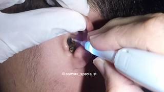 Mans MASSIVE Earwax Softened and Removed with Hydrogen Peroxide [upl. by Eras]