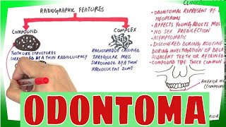 Odontoma  Types Clinical features Histopathological Features amp Treatment [upl. by Dlorad988]