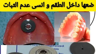 الحل النهائي و الاقتصادي لتثبيت طقم الأسنان المتحرك في الفم بقوة Prothèse dentaire amovible [upl. by Erihppas704]