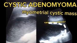 uterine Cystic Adenomyoma A Detailed Ultrasound Examinations [upl. by Ojimmas]