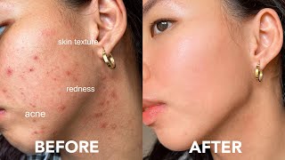 EASY WAY TO GET RID OF ACNE tiny bumps redness texture acne scars [upl. by Gingras198]