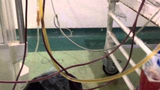 Plasmapheresis in Renal transplant with severe AMR Dr Sandeep kumar garg [upl. by Alyekahs]