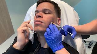 Bellafill Injections  Acne Scars  West Hollywood CA  Dr Jason Emer [upl. by Gretna769]