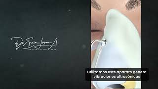 Rinoplastia Ultrasónica [upl. by Hike439]