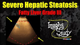 Severe Hepatic Steatosis  Grade III Fatty Liver  Ultrasound  Case 348 [upl. by Lavinie]