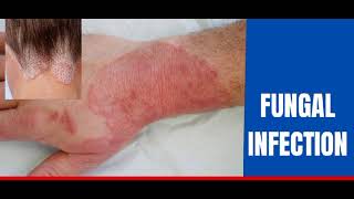 Fungal infectionskin Dr how to treat fungal infection [upl. by Yelyah]