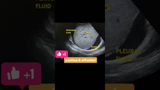 Ascites And Pleural Effusion abdomen usg ascites pleuraleffusion [upl. by Uon551]