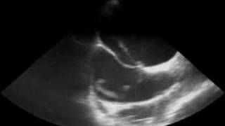 Thrombus in a Patent Foramen Ovale [upl. by Ilsel874]