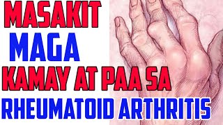 Masakit Maga Kamay at Paa sa Rheumatoid Arthritis  Payo ni Doc Willie Ong 116 [upl. by Sankaran]