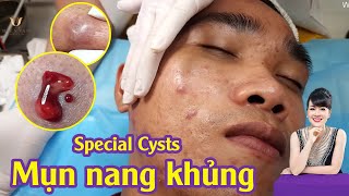 Extract some Special Cysts at hien van spa  Điều trị mụn nang hiệu quả TPHCM  Trọng Hữu  583 [upl. by Orsay42]