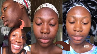 Kojie San kojic acid skin lightening Soap  3 weeks honest Review with before and after [upl. by Row346]