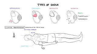 Circulatory Shock  Classification compensatory mechanisms amp pathophysiology  Hypovolemic shock [upl. by Mercier806]