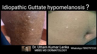 White spots on skin in old age idiopathic guttate hypomelanosis Treatment and prevention [upl. by Aerdied]