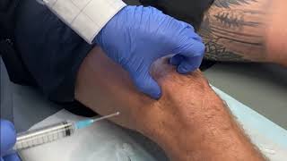 KNEE Intraarticular injection of Local Anaesthetic and Steroid [upl. by Lander]