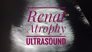 Renal Atrophy Ultrasound [upl. by Adnalro785]