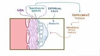 Membranous Glomerulonephritis  Renal Pathology  Osmosis [upl. by Aidiruy]