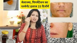 Pigmentation Treatment  मेलाज्मा पिगमेंटेशन लिव्हर खराब होने का संकेत 3 बेहतरीन उपाय [upl. by Atina]