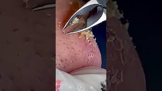 Skincare  Blackheads Removal 169 skincare skincare blackheads blackheads [upl. by Mcmullan]