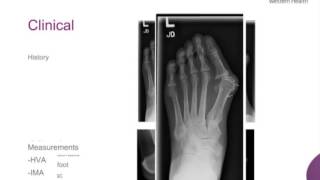 Hallux Valgus Rigidus by Dr Marc Friso [upl. by Hadden332]