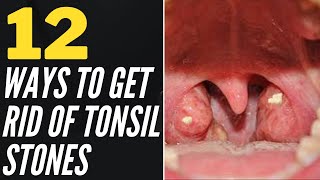 Waterpik Tonsil Stones → 4 Tips On Tonsil Stone Removal With A Water Flosser [upl. by Rothmuller214]