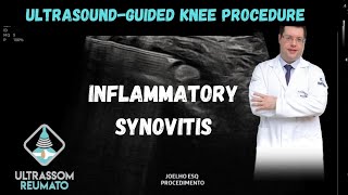 UltrasoundGuided Procedure in Knee Inflammatory Synovitis [upl. by Alurta]