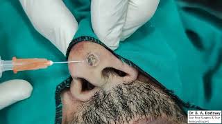 Scarless Nasal mole removal [upl. by Arret]