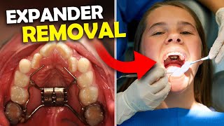 Getting Palatal Expander OFF… What happens when you get your Expander Off  McKinney Orthodontist [upl. by Nofets]