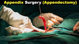 How Does Appendectomy Works  Appendicitis treatment UrduHindi [upl. by Etom577]