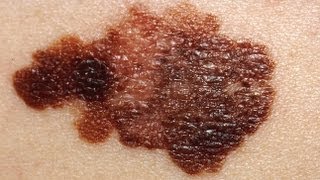 What Does Skin Cancer Feel Like DermTVcom Epi 499 [upl. by Hance]